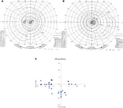 Cortical Thickness Related to Compensatory Viewing Strategies in Patients With Macular Degeneration